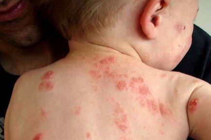 Psoriasis gyermekek okoz, a tünetek és a kezelés - útmutató a bőrbetegségek