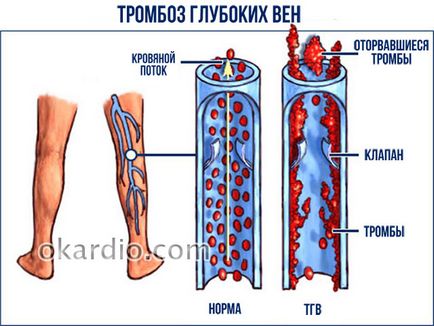 A vérrög a lábában tünetek és a kezelés, okok, diagnosztikai módszerek