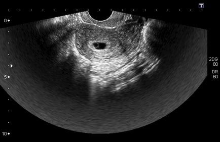 Ultrahang diagnosztika terhesség kis távon