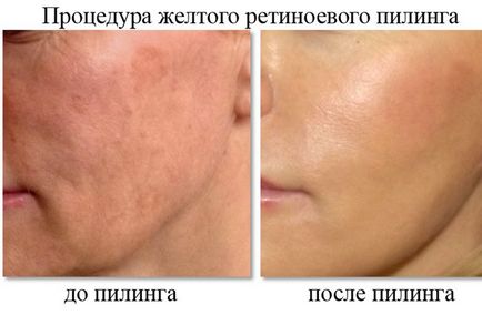 Sárga peeling arc véleménye, fotók, eredmények előtt és után