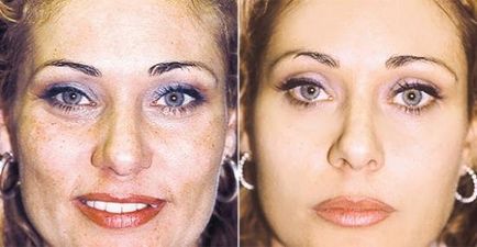 Sárga peeling arca, mi az, hogy milyen gyakran csinálni, cosmetologists vélemények és fotók előtt és után (sárga) Sárga peeling arca, mi az, hogy milyen gyakran csinálni, cosmetologists vélemények és fotók előtt és után