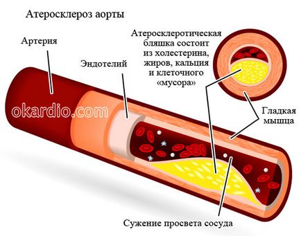 Atherosclerosis az aorta hogy