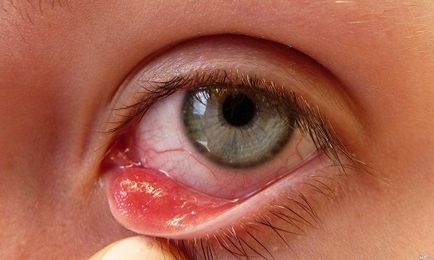 Herpes zoster kezelésére Herpes zoster kezelésére