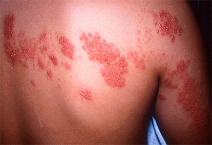 Herpes zoster kezelésére Herpes zoster kezelésére