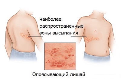 Herpes zoster kezelésére