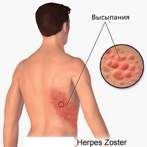 Herpes zoster kezelésére