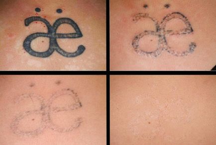Hogyan lehet csökkenteni a tetoválás