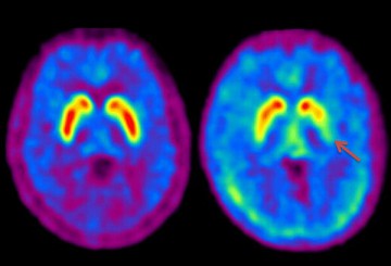 Parkinson-kór és annak kezelése