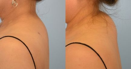 Hogyan lehet eltávolítani a lerakódásokat a nyak
