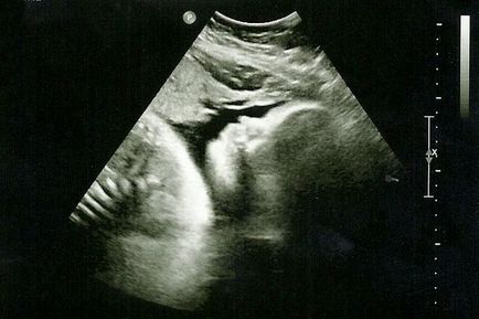 Ultrahang a terhesség harmadik trimeszterében