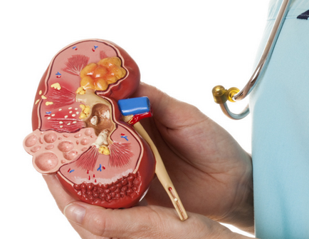 glomerulonephritis meg