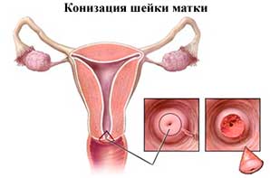 nyaki kúp biopszia - az optimális kitermelés