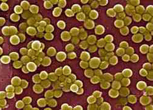 A kezelés a Staphylococcus aureus az orrban