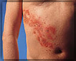 Herpes zoster zsindely kezelés