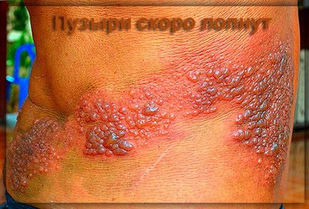 Herpes zoster zsindely kezelés
