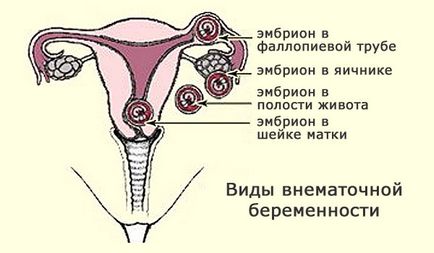 Hogyan és mikor jelenik meg a méhen kívüli terhesség