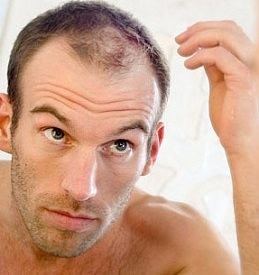 17. A legjobb orvosság a hajhullás a férfiak