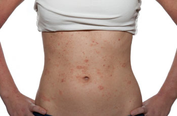 Allergiás a bőrt, okoz, a tünetek, a kezelés, típusú allergének betegség