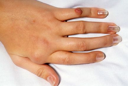 Osteoarthritis az ujjak - tünetek és kezelés