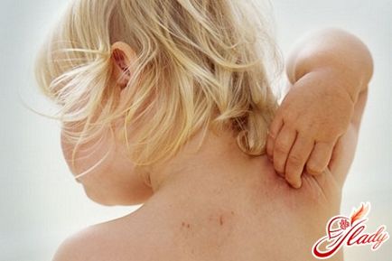 Az atópiás dermatitis kezelt gyermekeknél népi jogorvoslati