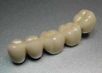 Melyik a jobb - metalloplastmassa vagy fémkerámia és protézisek (fémkerámia) Melyik a jobb - metalloplastmassa vagy fémkerámia és protézisek