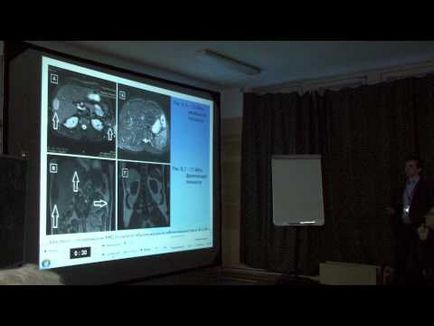Mit jelent a MRI a máj, és ez jobb, ha nem CT vagy MRI (jobb) Mit jelent a MRI a máj, és ez jobb, ha nem CT vagy MRI
