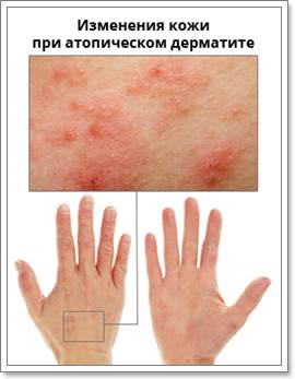 Mi az atópiás dermatitisz és hogyan kell gyógyítani a tünetek és a kezelés, a táplálkozás, videó