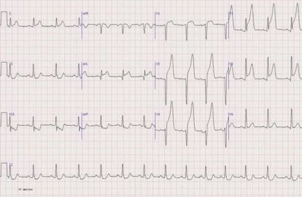 EKG gyermek (ek) EKG gyerek