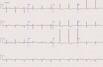 EKG gyerek (beütés fog térni) EKG gyerek