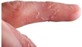 Ekcéma az ujjak - kezelés, a tünetek és fotók