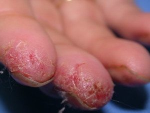 Ekcéma az ujjakon - kezelés, a tünetek és fotók