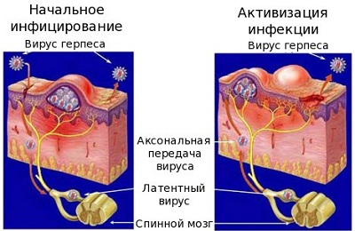 Herpes az ajkak, mi az, okai és mit kell csinálni (ok) Herpes az ajkak, mi az, okai és mit kell csinálni