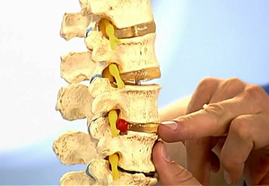 Spinal sérv tünetek és a kezelés, okok és a tünetek, fotók