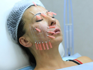 Melyek a szálak egy face-lift, és mennyi fonal van szüksége jellemzői a lift (vannak) Melyek a szálak egy face-lift, és mennyi fonal van szüksége jellemzői harisnyatartó