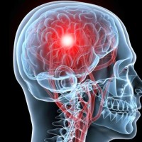 Hogyan lehet csökkenteni koponyán belüli nyomás hatékony módszerek