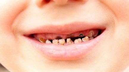 Hogyan kell menteni a rothadó fogak miért rothad, a következményeket a test, mit kell tenni