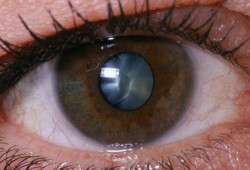 Cataract kezelés népi jogorvoslati 1