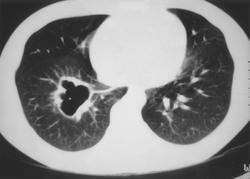 Lung ciszta okok és a tünetek, diagnózis és kezelés