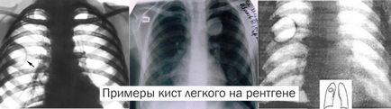 Lung ciszta tünetei, kezelése és népi jogorvoslati