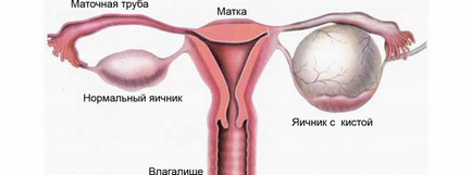 petefészek ciszta műtét, kezelés nélkül népi jogorvoslati és a kábítószer