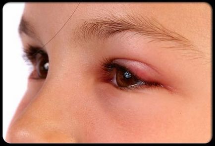 Red Eye fehérjék okait, hatásait és kezelések