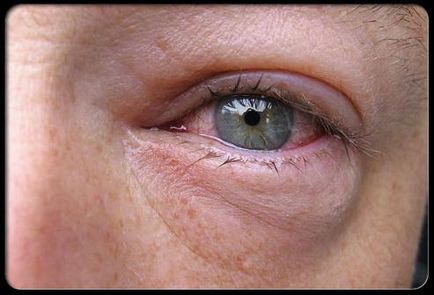 Red Eye fehérjék okait, hatásait és kezelések
