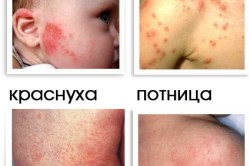 Allergia kezelésére az arcon az újszülött különbségek bőrkiütések, fajta (videó)