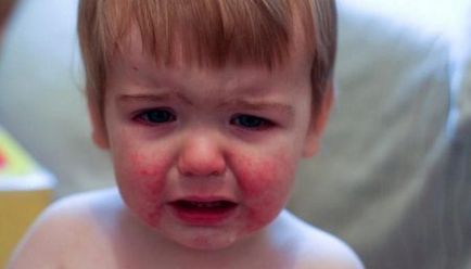 Atópiás bőrgyulladás kezelésére gyermekeknél népi jogorvoslati (26 fotó)