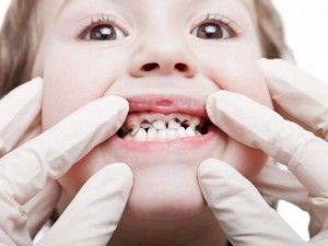 caries kezelést otthon és a fogászatban