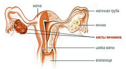 A kezelés petefészek ciszták emberek jogorvoslatok
