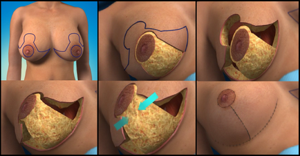 Reduction mammoplasty - mi ez, és milyen esetekben szükséges
