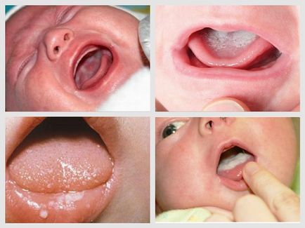 A szájpenész újszülöttek és a csecsemők kezelésére, gyógyszerek