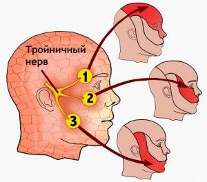 Neuralgia arcideg tünetek és a kezelés