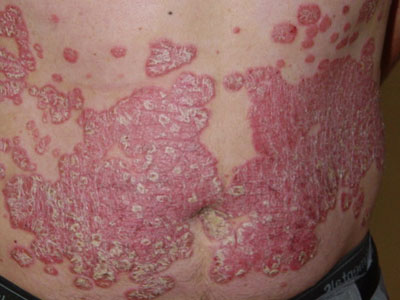 Atópiás dermatitis tünetei és kezelése
